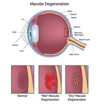 macular degeneration