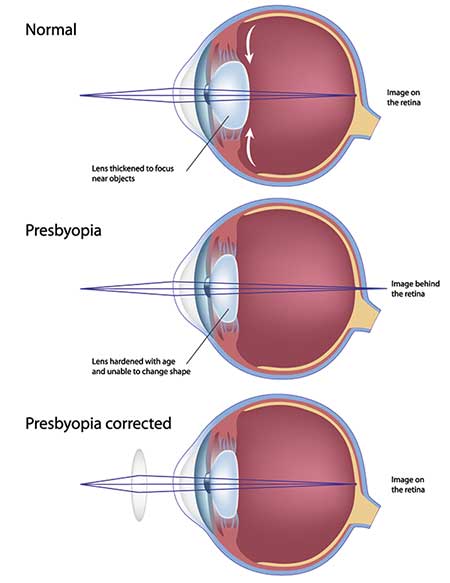 presbyopia